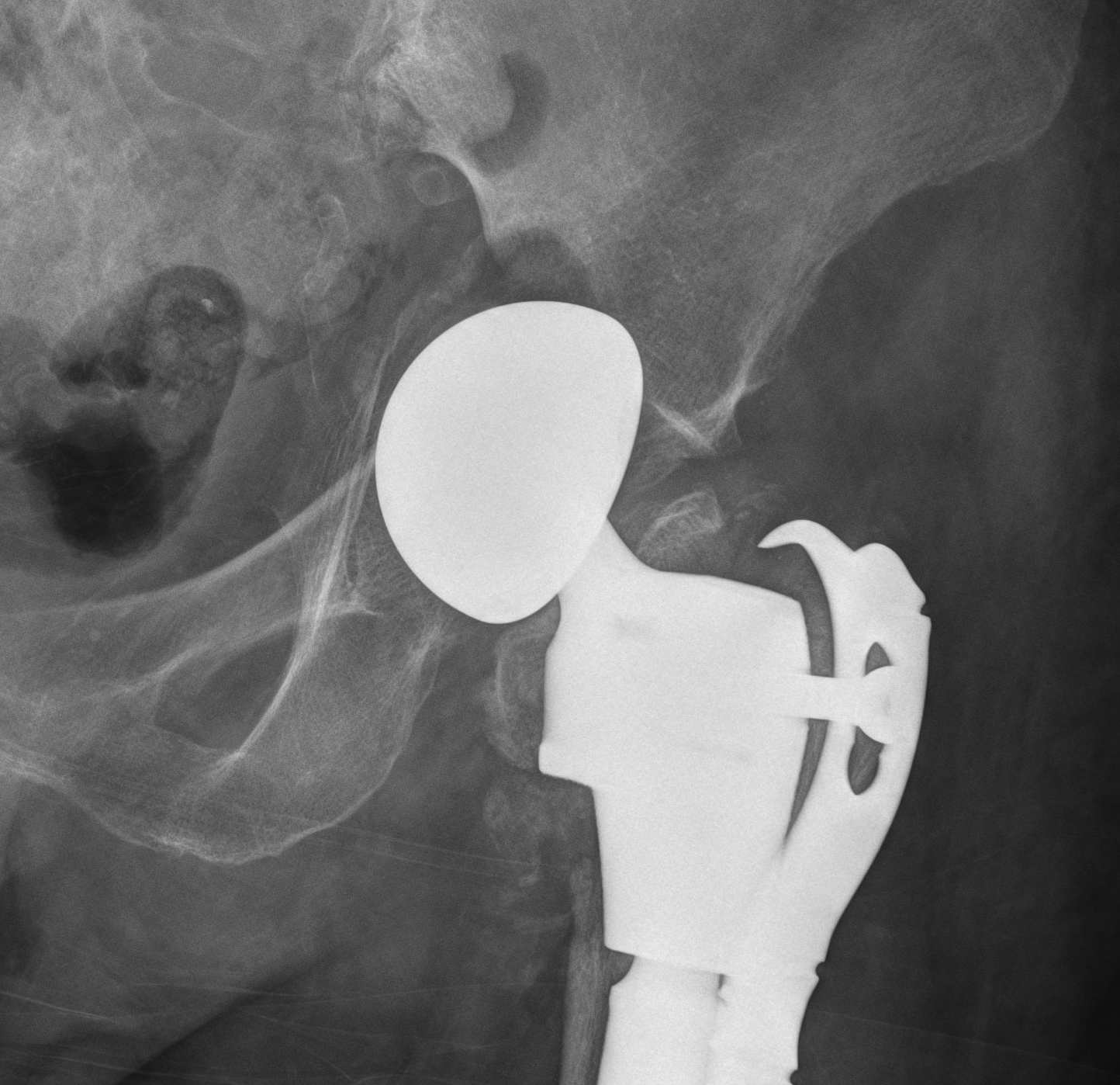 Bipolar Acetabular Destruction 1